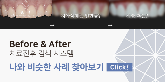 앞니라미네이트가격 부담 갖지말고! 관련 이미지 2