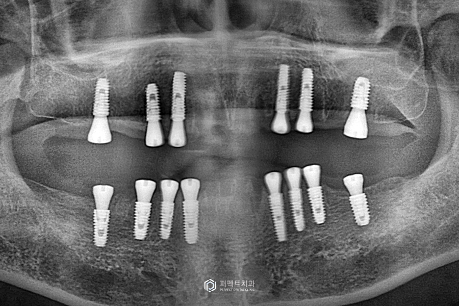살릴 수 있는 치아가 없다면?❌｜전체임플란트 수복 관련 이미지 4