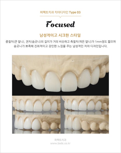 강남역치과, 앞니 라미네이트 가격 관련 이미지 5