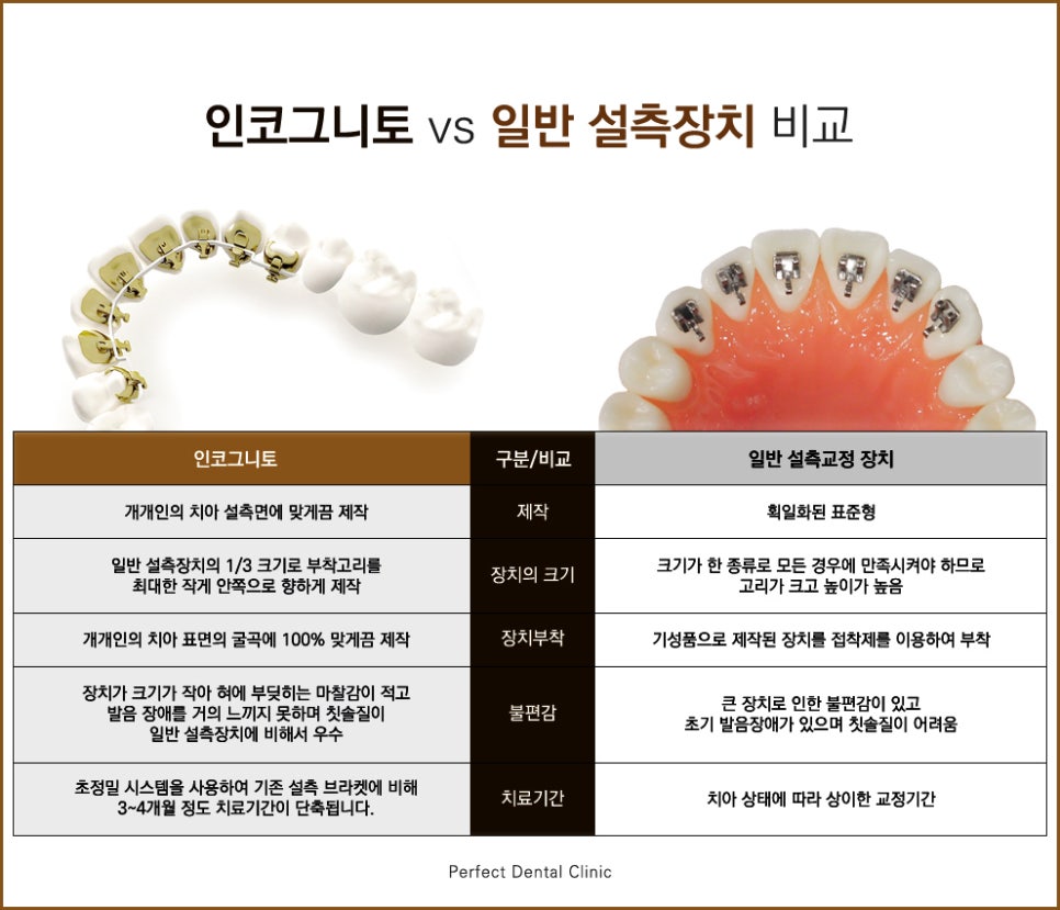 치아안쪽에 부착하는 설측교정! 관련 이미지 6