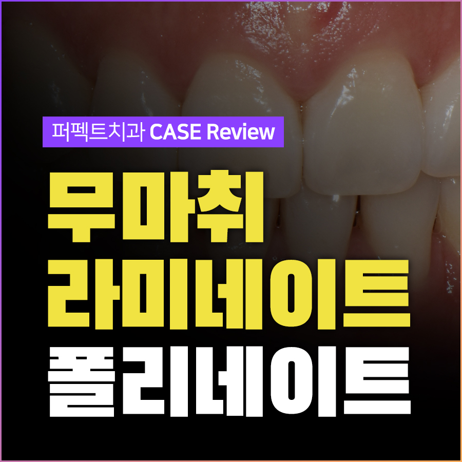 無통증&middot;무마취 라미네이트, 폴리네이트 치료 결과 관련 이미지 1