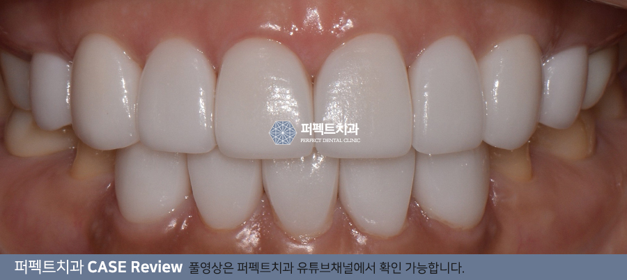 오래된 라미네이트 재시술, 보철물 교체 (잇몸노출,변색) 관련 이미지 3