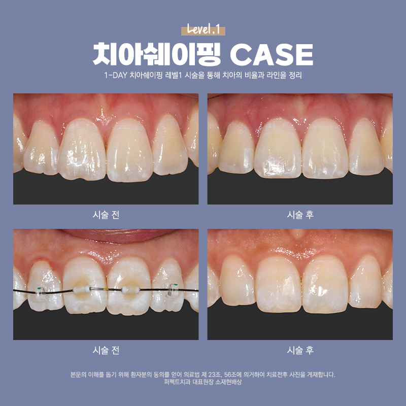 울퉁불퉁한 치아가 고민되면 치아다듬기! 관련 이미지 3