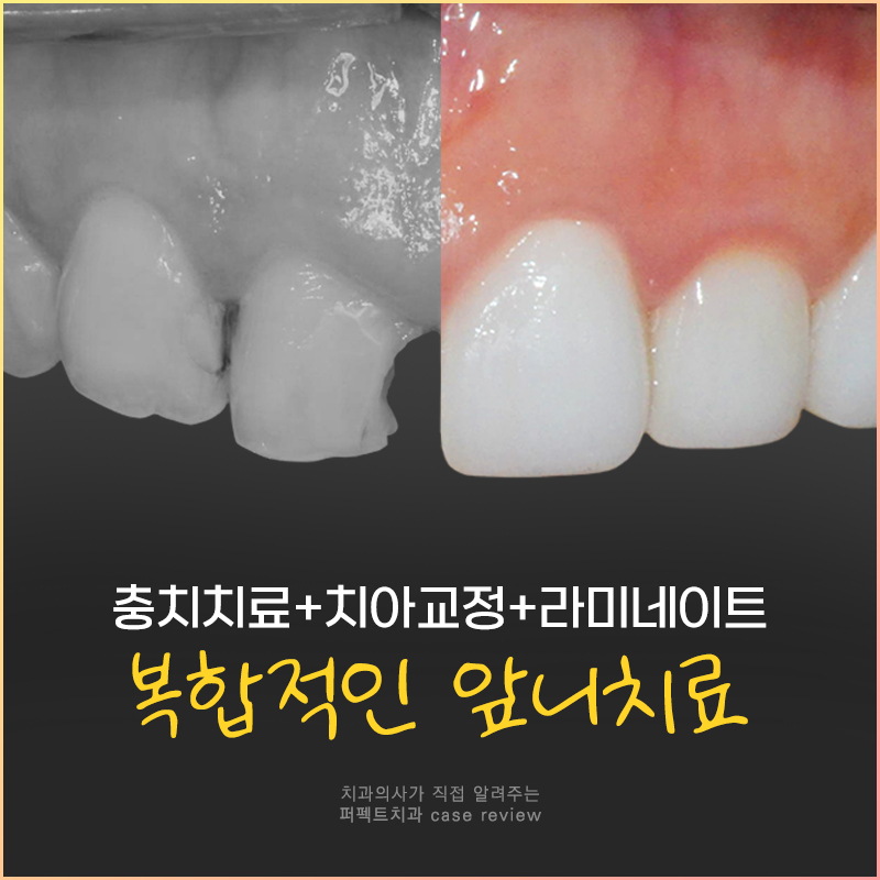충치치료+교정 후 라미네이트, 세가지 복합적인 치료의 기간은?! 관련 이미지 1