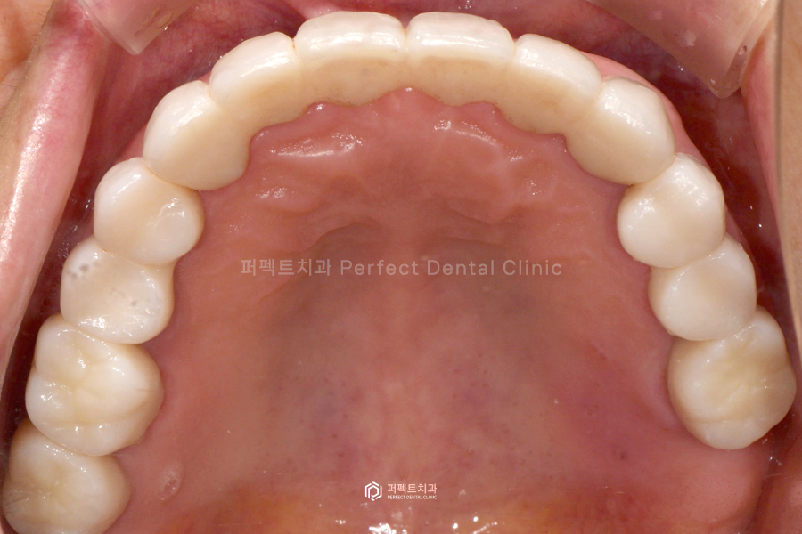 윗니 전체 신경치료 했다고?😱 교합평면이 뭐길래 관련 이미지 12