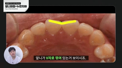 깨진 앞니 치료, 라미네이트로! 관련 이미지 5