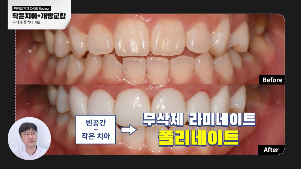 왜소치와 개방교합 문제를 한 번에 개선하다. 관련 이미지 6