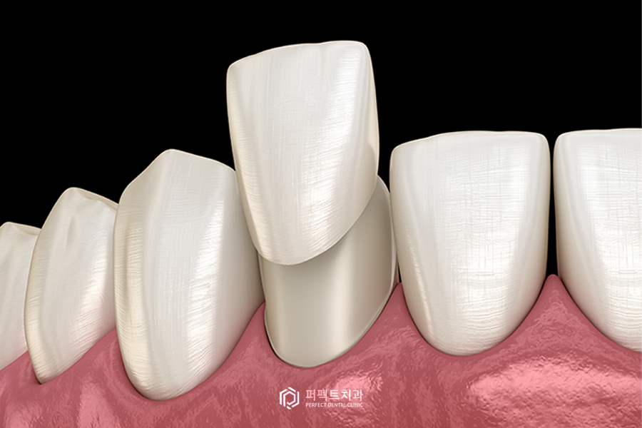 치과 크라운 나에게 맞는 종류가 있다? 관련 이미지 3