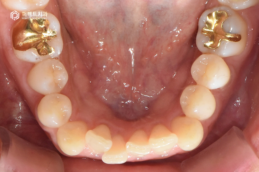 삐뚤거리는 아랫니를 6개월만에 반듯하게?! 관련 이미지 3