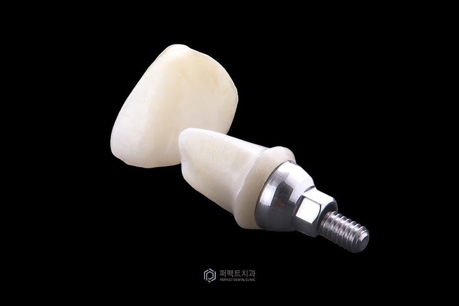 임플란트 보철 탈락②｜크라운이 빠지는 이유, 두 번째 관련 이미지 1