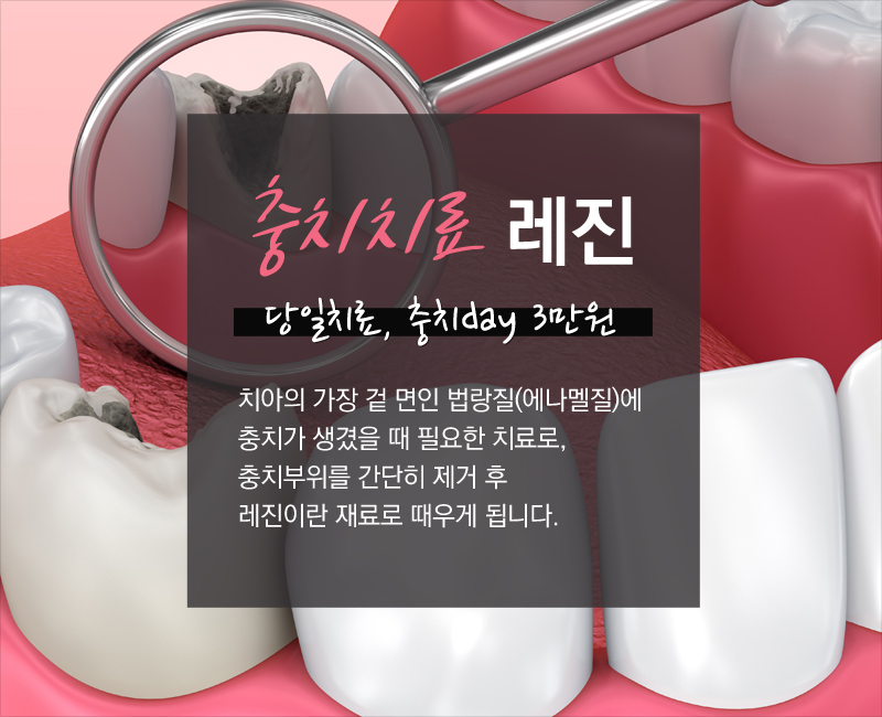 레진치료&충치치료 급한 사람들에게 좋은 소식! 관련 이미지 1
