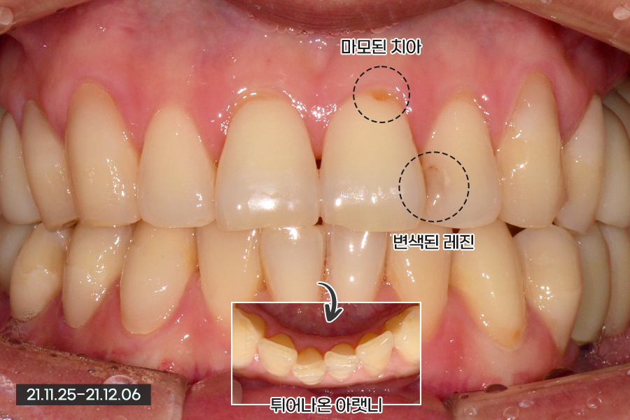 남자 라미네이트, 얼마나 밝게 가능할까? 관련 이미지 2