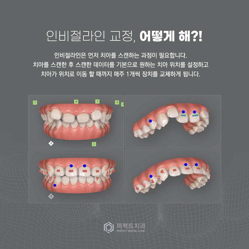 투명교정 인비절라인이란 관련 이미지 3