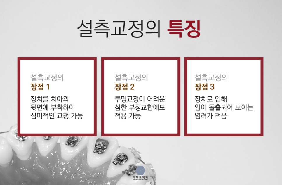 치아안쪽에 하는 설측교정^^ 관련 이미지 6