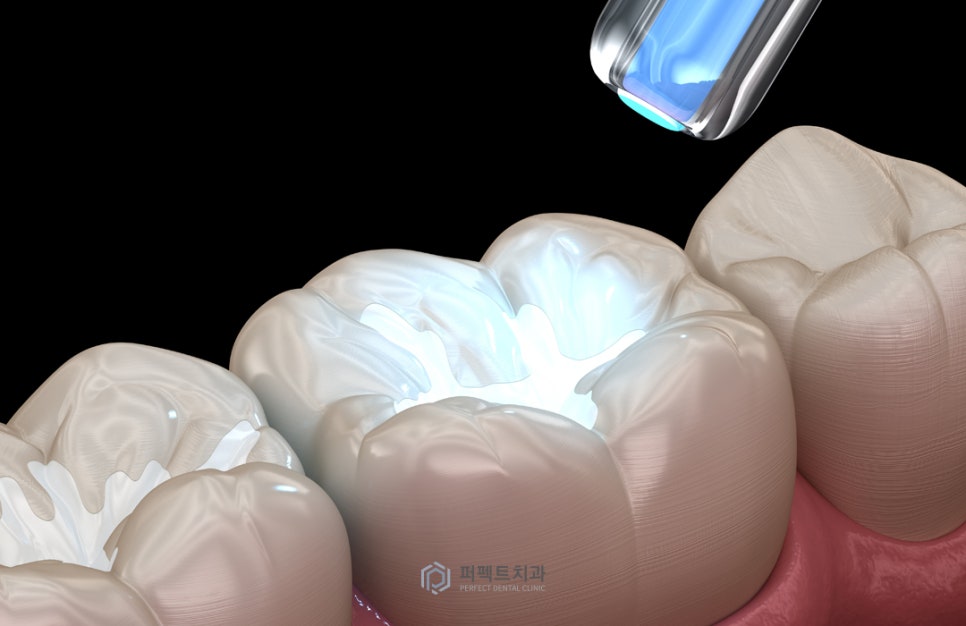 미룰수록 어려운 충치치료, 초기에 치료해요! 관련 이미지 5