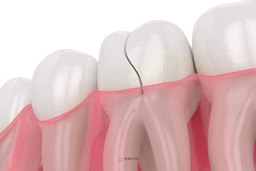 치아크랙｜치아에 금이 갔을 때 나타나는 증상은? 관련 이미지 2