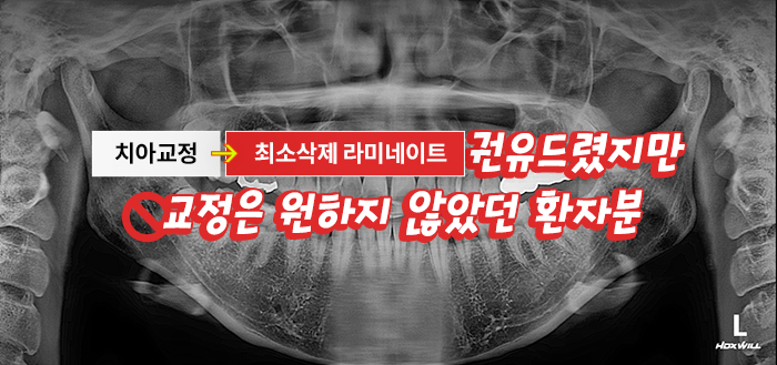 앞니 돌출,벌어짐,변색.. 교정이 싫다면 이 방법으로!? 관련 이미지 3