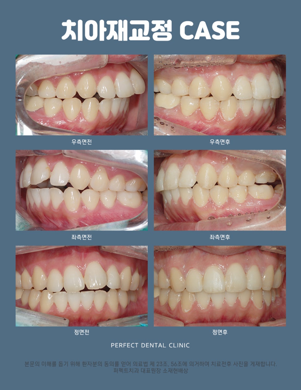 교정 후 다시 치아가 틀어졌다면? 치아재교정 하세요! 관련 이미지 3