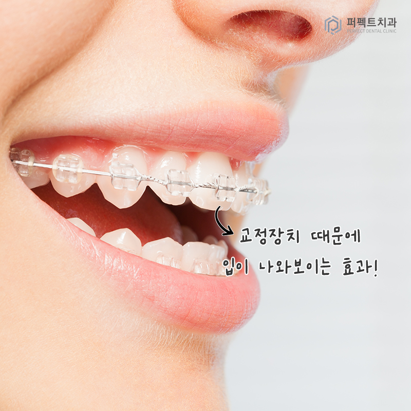 치아교정 중 코성형 해도 될까요? 관련 이미지 2