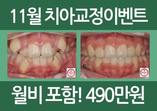 [교정치료]치아교정이벤트 관련 이미지 5