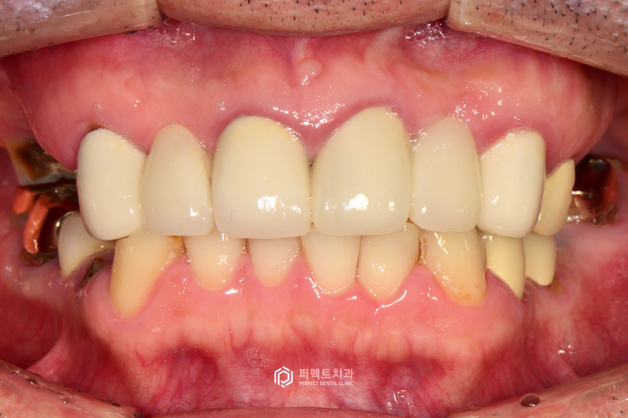 어금니가 없어 앞니로 음식을 드셨던..😰 어떻게 변했을까? 관련 이미지 8