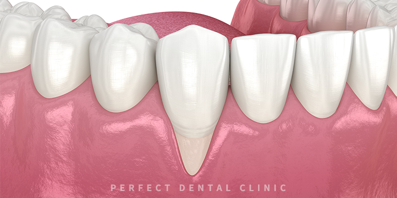 잇몸 퇴축이 걱정된다면? 관련 이미지 1