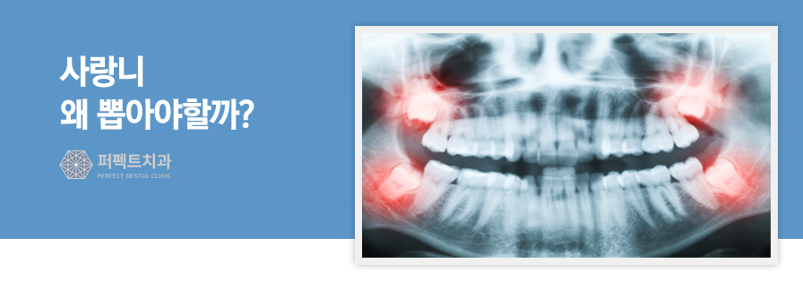 사랑니 발치 후 필요한 관리법은? 관련 이미지 2
