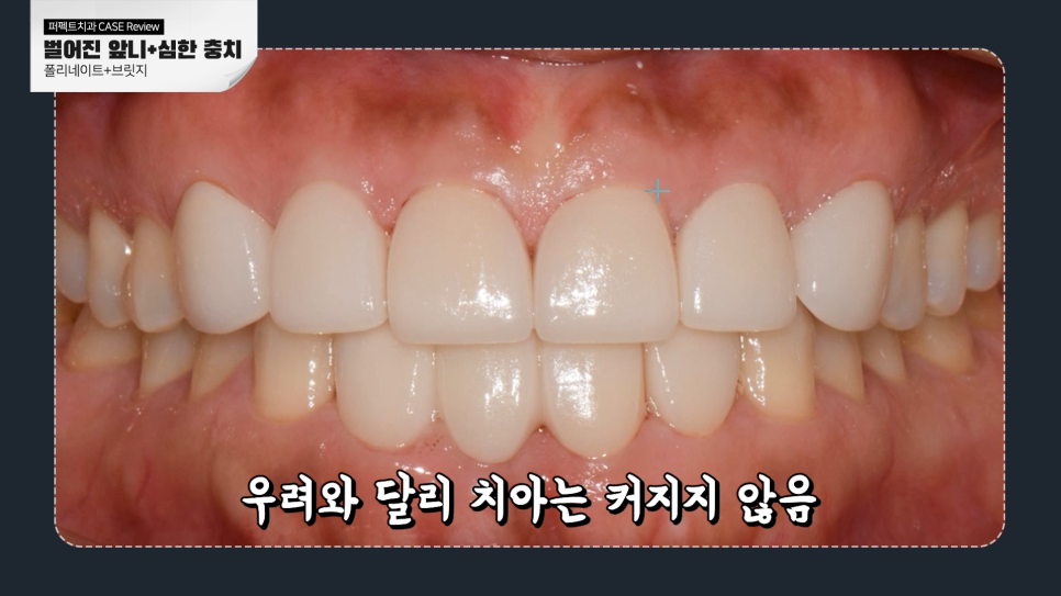 앞니충치, 벌어짐 동시에 치료하는 방법 관련 이미지 6