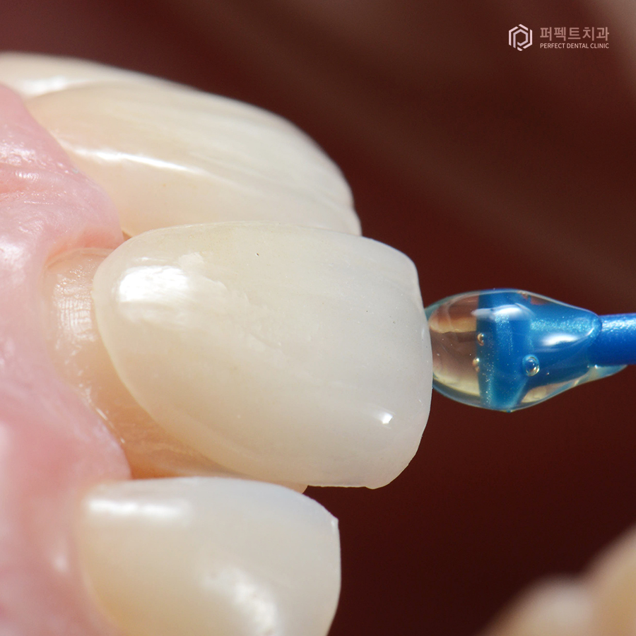 라미네이트와 치아미백 중 어떤 것을 먼저 해야할까요? 관련 이미지 3