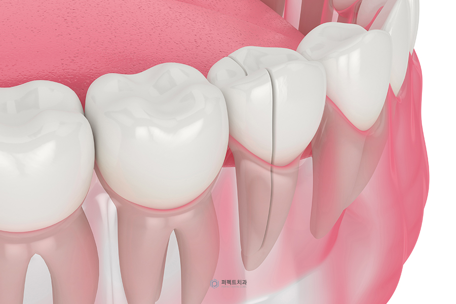 치아크랙｜치아에 금이 갔을 때 나타나는 증상은? 관련 이미지 1