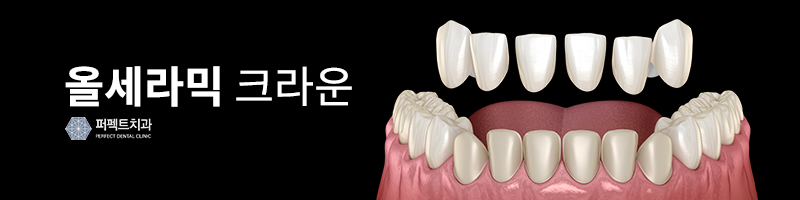 라미네이트와 올세라믹 차이점은? 관련 이미지 3