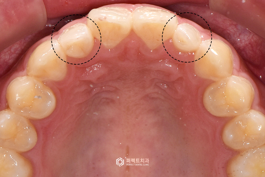 6년 전 라미네이트 교체&연장, 그 이유는?😯 관련 이미지 3