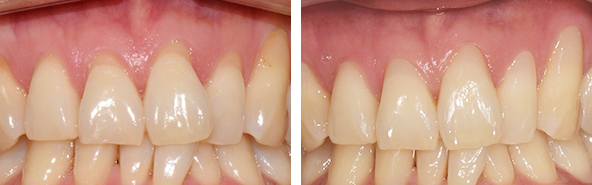 앞니 레진 변색 비용 얼마? 관련 이미지 4
