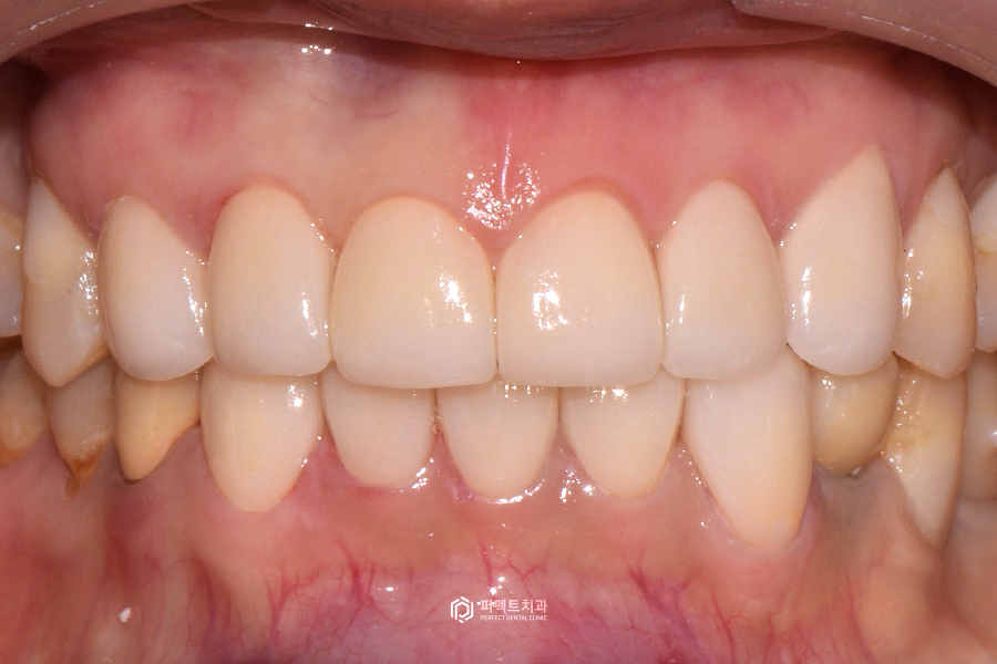 레진으로 변색+마모된 치아, 개선 방법은? 관련 이미지 6