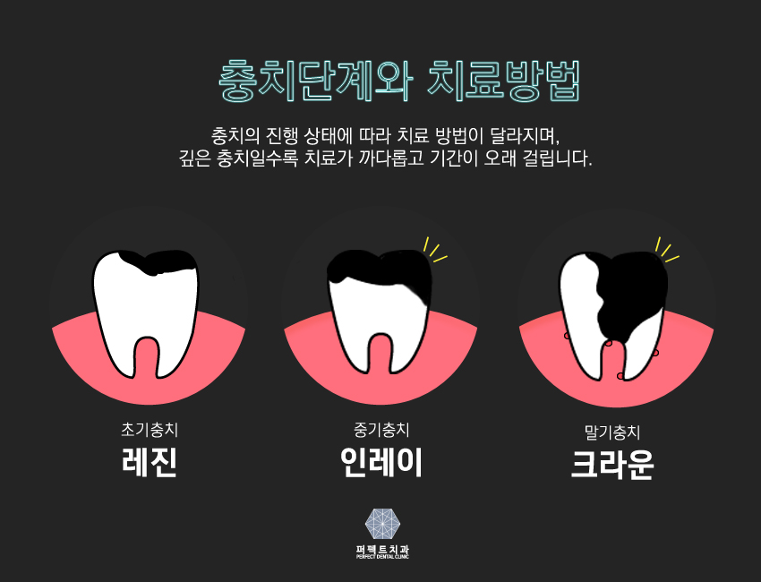 초기충치 레진으로 하자! 관련 이미지 2