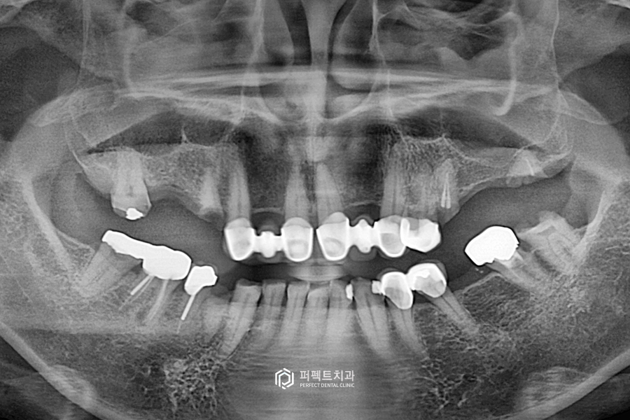 어금니가 없어 앞니로 음식을 드셨던..😰 어떻게 변했을까? 관련 이미지 2