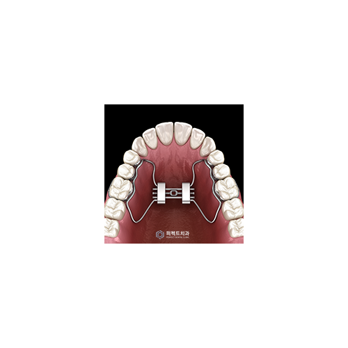 MARPE 악궁확장장치로 위턱 넓히기?! 관련 이미지 6