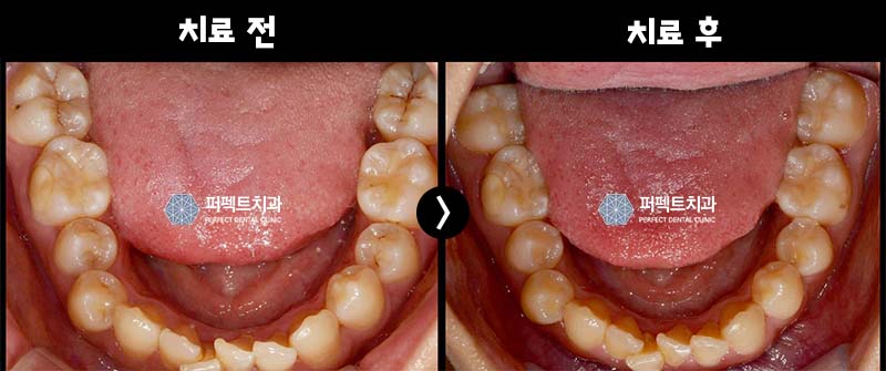 벌어진 앞니 레진으로 치료 관련 이미지 4