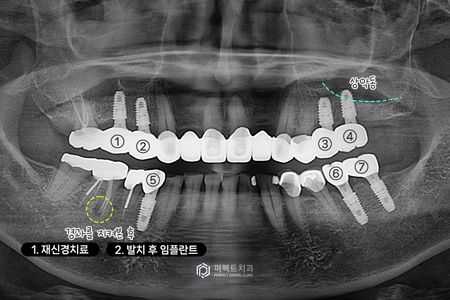 어금니가 없어 앞니로 음식을 드셨던..😰 어떻게 변했을까? 관련 이미지 5