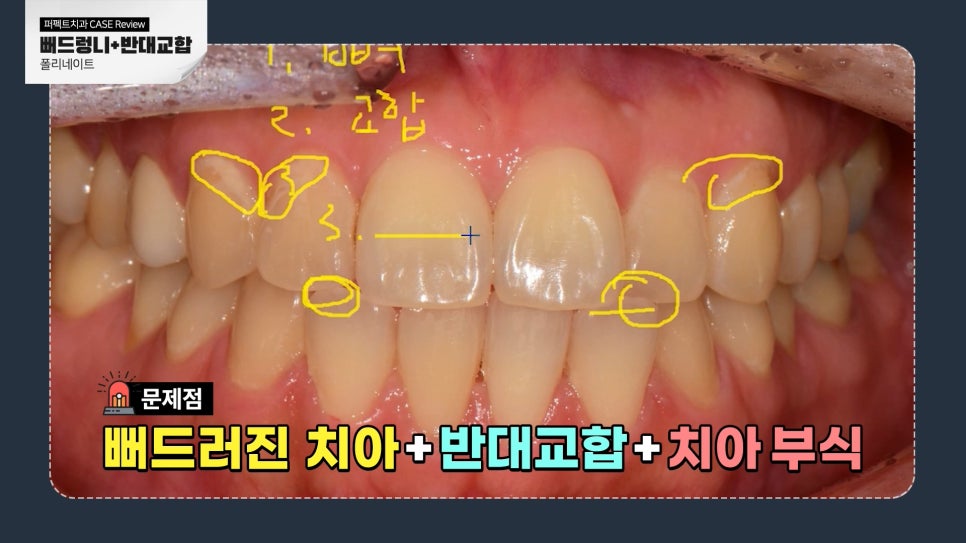 반대교합, 뻐드러진 치아 라미네이트 가능?! 관련 이미지 2