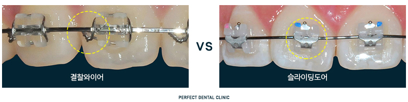 퍼펙트치과 전체교정 비용 궁금해? 관련 이미지 1