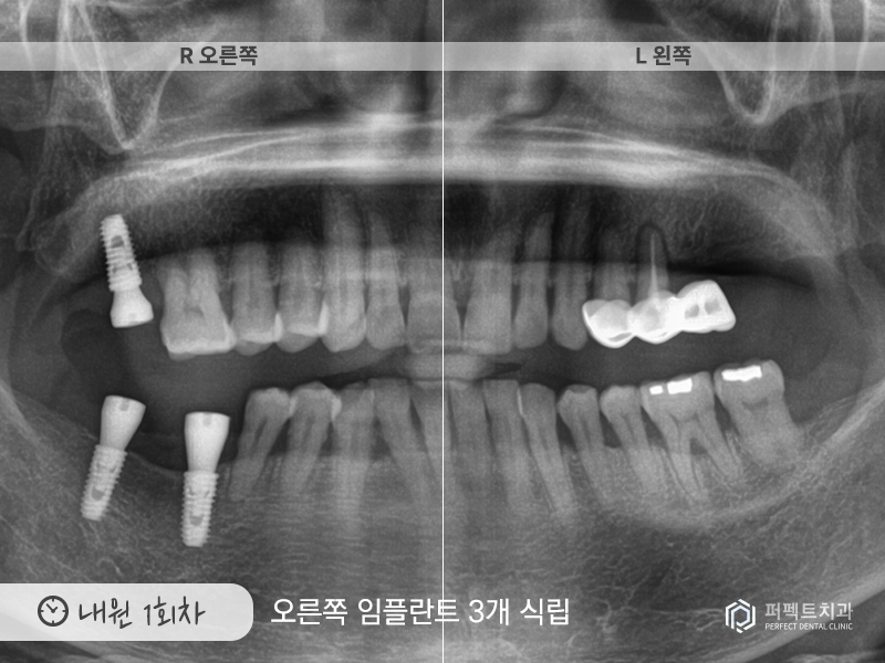 장거리+다수의 임플란트 케이스 관련 이미지 5