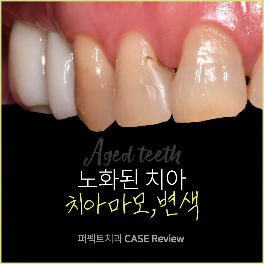 노화된 치아, 최소삭제라미네이트 관련 이미지 1