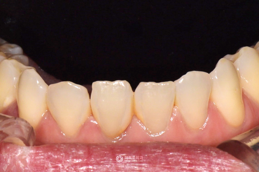 개방교합(open bite)을 라미네이트로 해결할 수 있을까? 관련 이미지 3