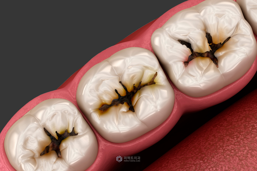 시린이의 원인 어떤 게 있을까? 관련 이미지 2