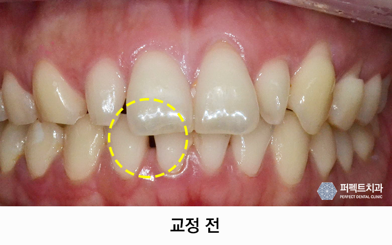 3개월 단기교정으로 빠르게! 관련 이미지 1