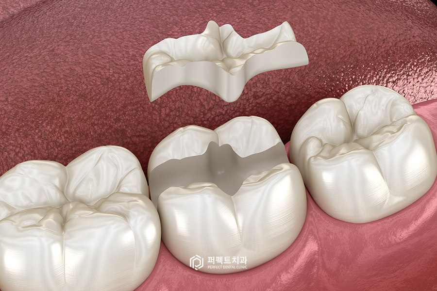 충치치료 후 치아가 시려요!(레진&인레이 치료 후) 관련 이미지 3