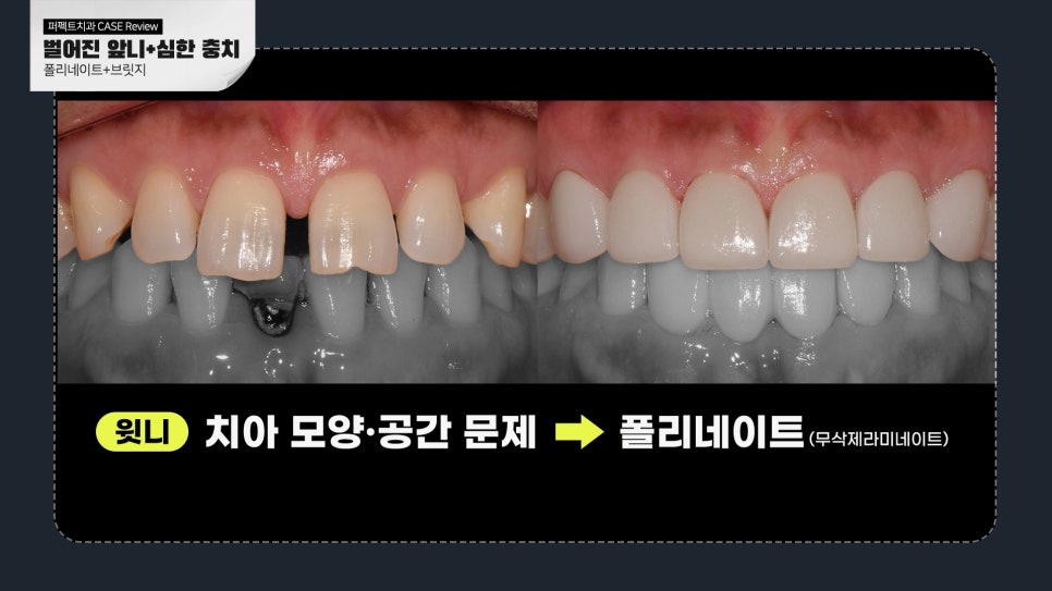 충치+벌어진앞니 라미네이트 case 관련 이미지 3