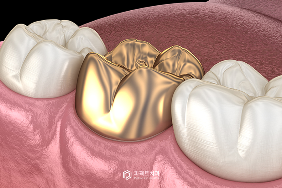 치과 크라운 나에게 맞는 종류가 있다? 관련 이미지 1
