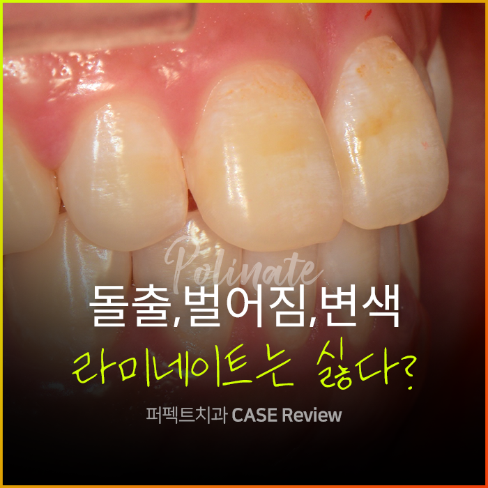 앞니 돌출,벌어짐,변색.. 교정이 싫다면 이 방법으로!? 관련 이미지 1